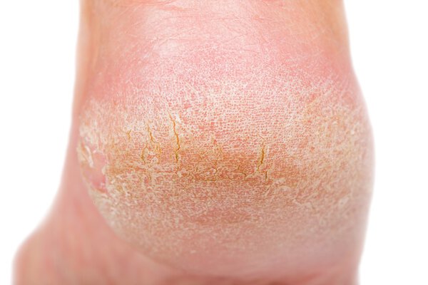 Dry skin on heel