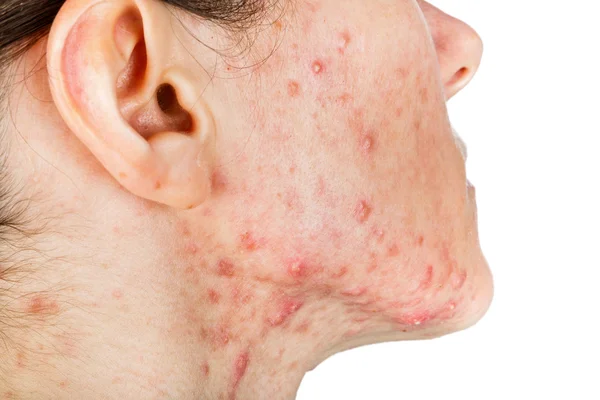 Young girl with skin problem — Stock Photo, Image