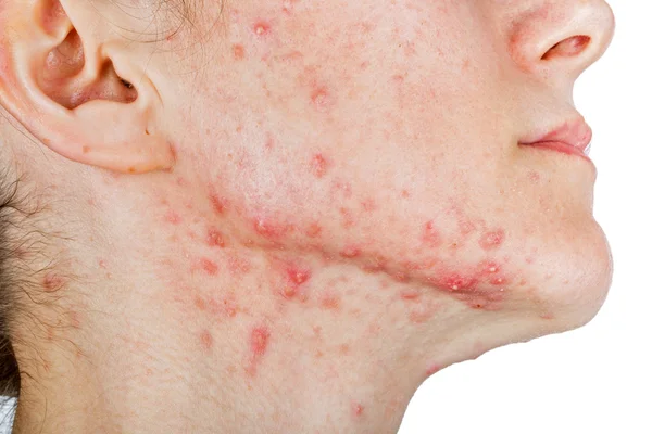 Jeune fille avec problème de peau — Photo