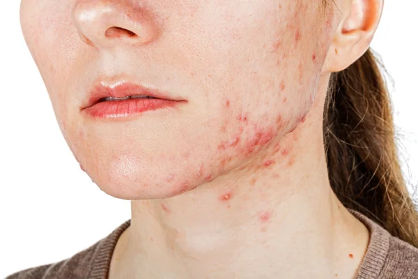 Jeune fille avec problème de peau — Photo