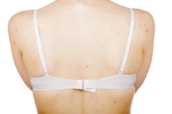 Acne skin on female back — Stock Photo, Image