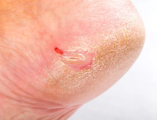 Dry skin on heel — Stock Photo, Image