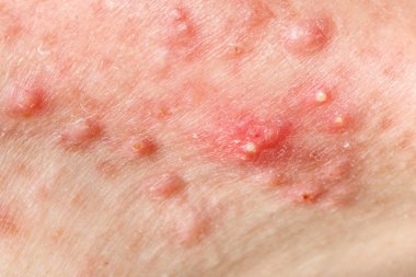 Nodular cystic acne skin clipart
