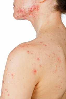 cilt sorunu ile genç kız