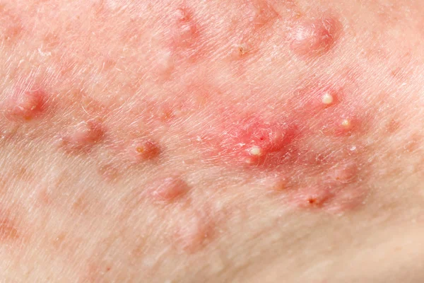 Pele nodular cística da acne — Fotografia de Stock