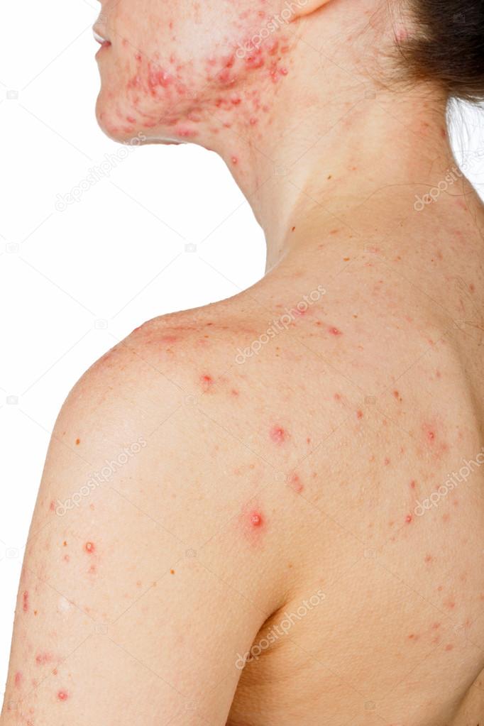 Young girl with skin problem