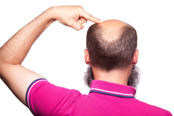 man alopecia baldness hair loss isolated.