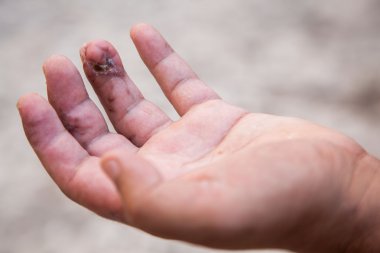 Damaged finger after operation. Man's hand with stitches and pins still in place from surgery to repair damage from Dupuytren's Contracture of pinky finger.