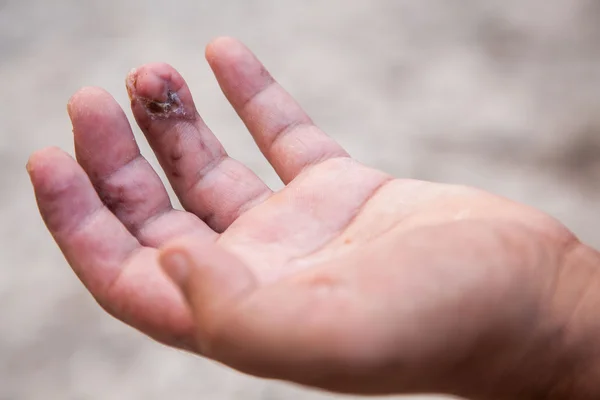 Damaged finger after operation. Man's hand with stitches and pins still in place from surgery to repair damage from Dupuytren's Contracture of pinky finger. — Stockfoto