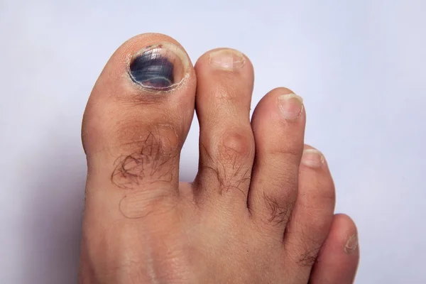 Bleus sur les ongles des orteils sur le pied droit — Photo