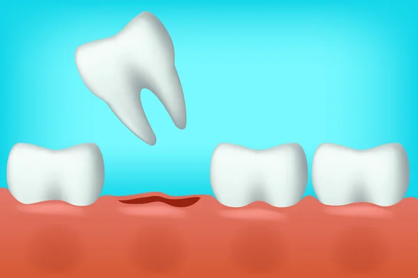 Teeth one fell — Stock Vector