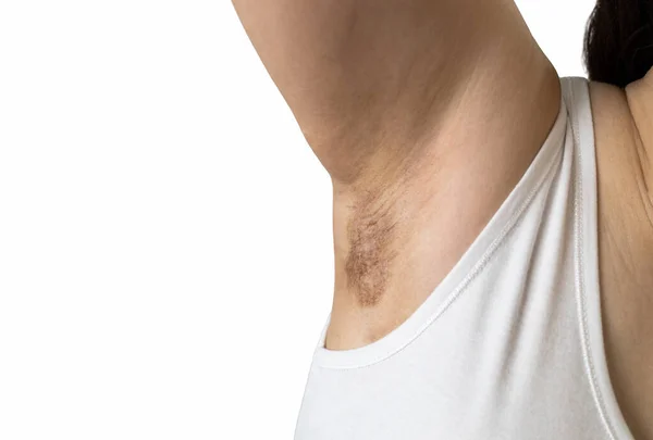 Ragazza Asiatica Che Mostra Una Cicatrice Sulla Pelle Delle Ascelle — Foto Stock