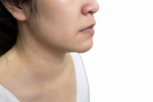 Yüzünde Terli Bir Cilt Aşırı Terleme Burnunda Ağzında Vücudunda Sıcak — Stok fotoğraf