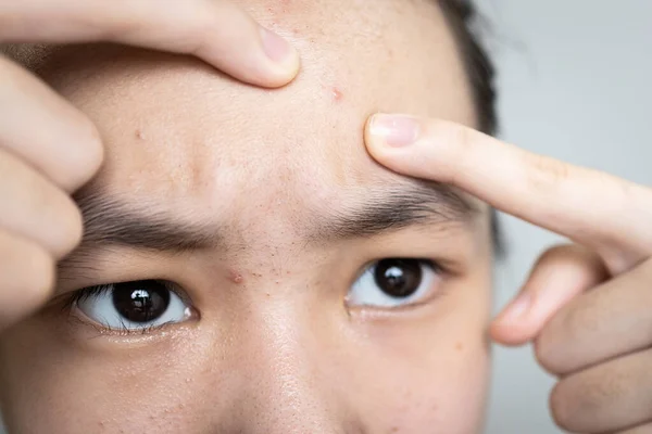 Asian teen girl squeezing pimples with fingers on her forehead,popping a pimple on face,a plug of sebum in a hair follicle causes acne,skin rejuvenation,acne treatment,beauty care and facial skin care