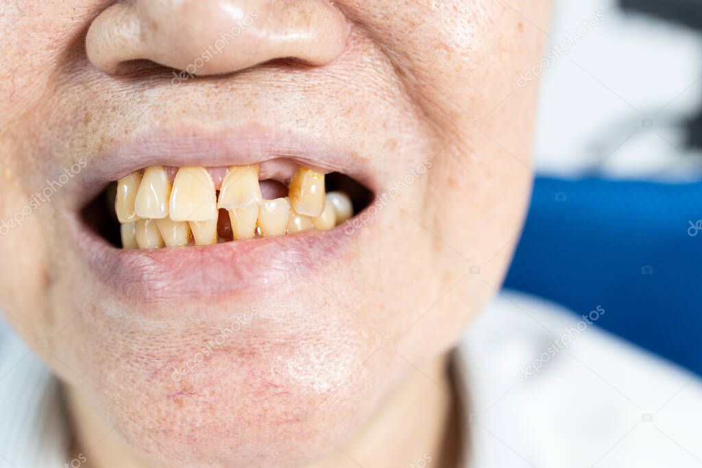 Close up,Mouth of old elderly with chipped a tooth,show a loose broken tooth,smile with bad yellow teeth,plaque tartar from eating tea,coffee and smoking of senior woman,toothache,bad breath problems