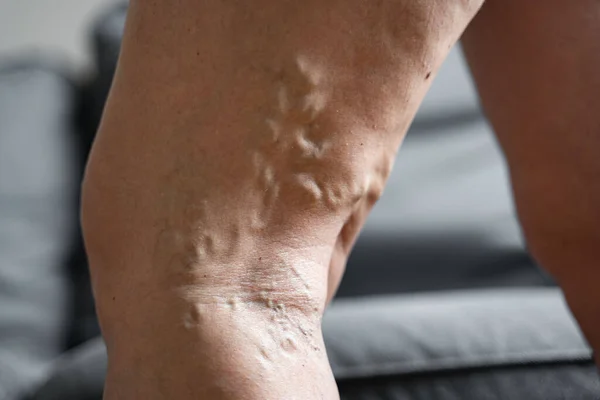 Varicose vein close up leg. Senior woman health problem. Foot with Diseased Veins. Health Care, Podiatry.