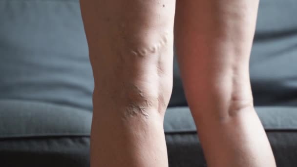 Varices près de la jambe. Problème de santé des femmes âgées. Pied avec veines malades. Soins de santé, Podiatrie. — Video