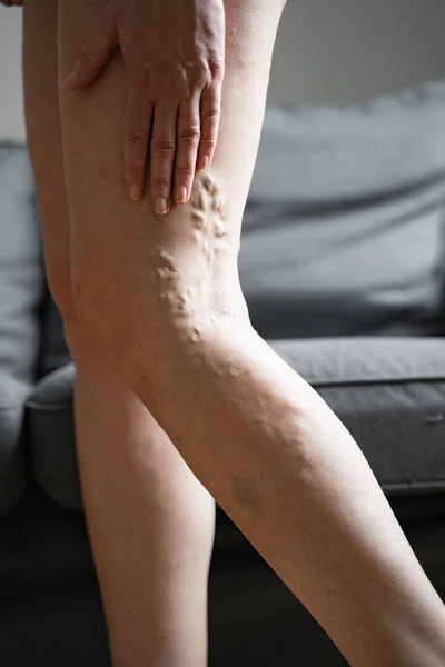 Varicose vein close up leg. Senior woman health problem. Foot with Diseased Veins. Health Care, Podiatry.