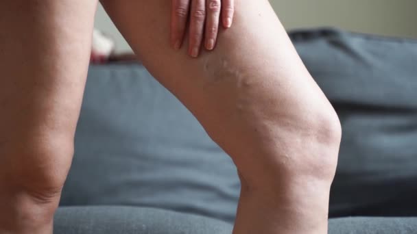 Η φλεβική κιρσός κλείνει το πόδι. Προβλήματα υγείας ηλικιωμένων γυναικών. Πόδι με άρρωστες φλέβες. Υγεία, Ποδιατρική. — Αρχείο Βίντεο