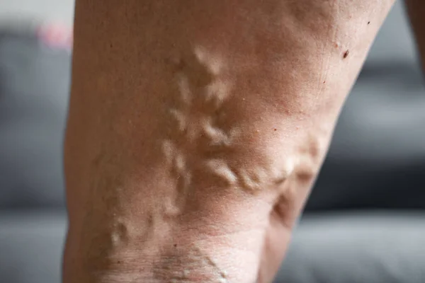 Varicose vein close up leg. Senior woman health problem. Foot with Diseased Veins. Health Care, Podiatry. — Stock Photo, Image