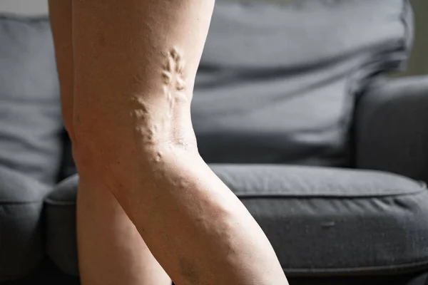 Varicose vein close up leg. Senior woman health problem. Foot with Diseased Veins. Health Care, Podiatry.