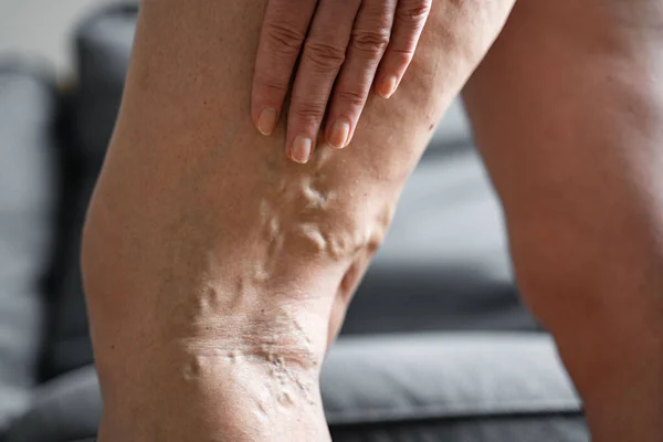 Varices près de la jambe. Problème de santé des femmes âgées. Pied avec veines malades. Soins de santé, Podiatrie. — Photo