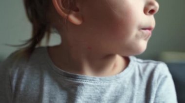 Yüzünde suçiçeği sivilcesi olan küçük bir kız. Kızamık bebek vücuduna bulaşır. Viral çocukluk virüsü hastalığı. Uçuk hastalığı, kaşıntı, ateş belirtileri.