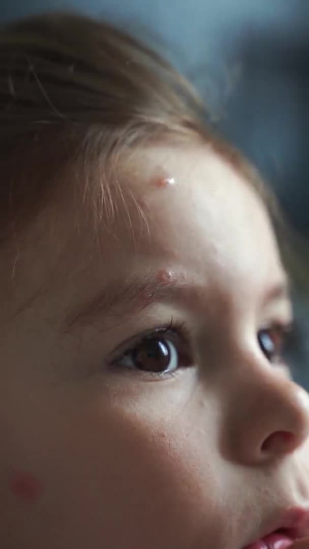 Flicka med vattkoppor mässling på kroppen. Varicellavirus smittsam barndom. Kliande röda blåsor, feber, smärtsymtom. — Stockvideo