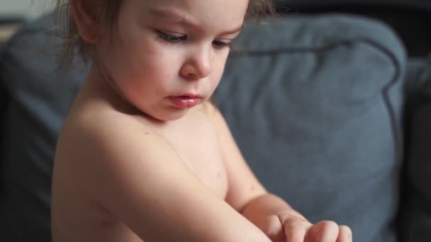 水痘を持つ幼児の女の子は体にはしか。バリケラウイルス小児感染症.かゆみ赤水疱,発熱,痛みの症状. — ストック動画