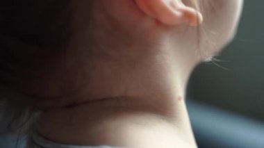 Vücudunda suçiçeği hastalığı olan küçük bir kız. Varicella virüsü çocukluğunda bulaşıcı bir hastalık. Kaşındıran kırmızı kabarcıklar, ateş, acı belirtileri.. 