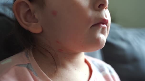 Niña con varicela sarampión en el cuerpo. Enfermedad contagiosa infantil por el virus de la varicela. Picor de ampollas rojas, fiebre, síntomas de dolor. — Vídeos de Stock