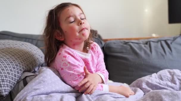 Toddler girl with chickenpox measles on the body. Varicella virus childhood contagious disease. Itchy red blisters, fever, pain symptoms. — Stock Video