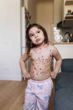 Vücudunda suçiçeği hastalığı olan küçük bir kız. Varicella virüsü çocukluğunda bulaşıcı bir hastalık. Kaşındıran kırmızı kabarcıklar, ateş, acı belirtileri.. 
