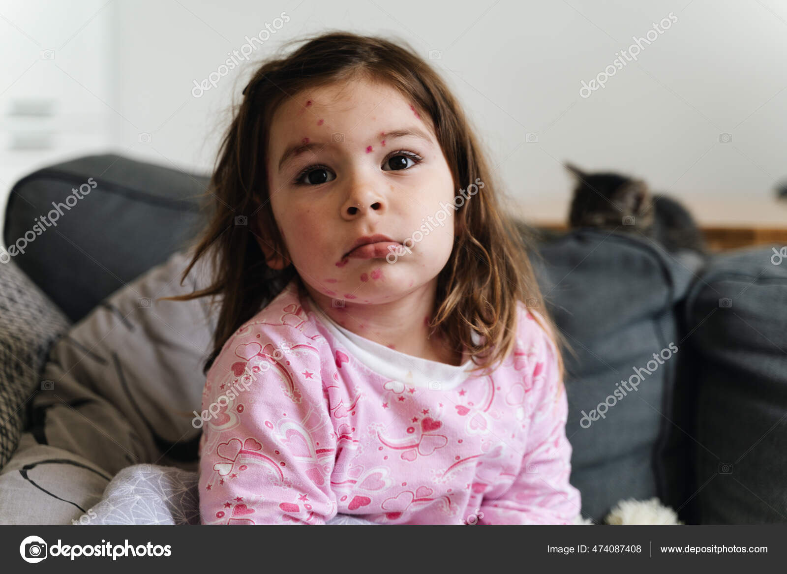 Toddler girl with chickenpox measles on the body. Varicella virus