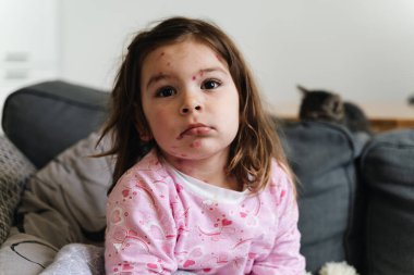 Vücudunda suçiçeği hastalığı olan küçük bir kız. Varicella virüsü çocukluğunda bulaşıcı bir hastalık. Kaşındıran kırmızı kabarcıklar, ateş, acı belirtileri.. 