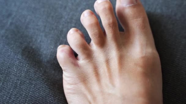 Ayak küçük parmak yaralanması. Ev kazasından sonra küçük bir ayak parmağı ağrısı ve çürüğü. Parmak kemiği kırığı. Çıplak ayaklı tırnaklar sağlıklı.. — Stok video
