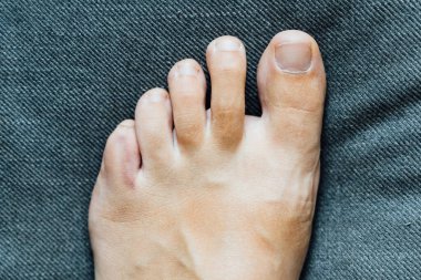 Ayak küçük parmak yaralanması. Ev kazasından sonra küçük bir ayak parmağı ağrısı ve çürüğü. Parmak kemiği kırığı. Çıplak ayaklı tırnaklar sağlıklı..