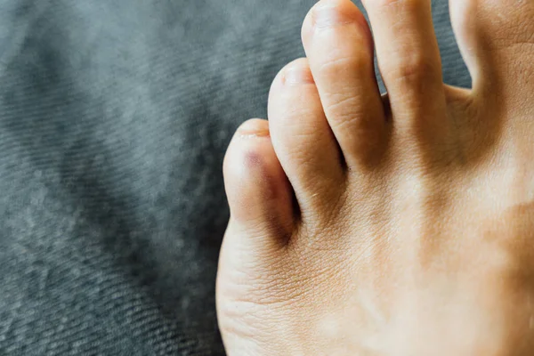 Lesión en el dedo meñique. Dolor en el dedo del pie y moretones después de un accidente. Fractura de falange. Uñas descalzas saludables. — Foto de Stock