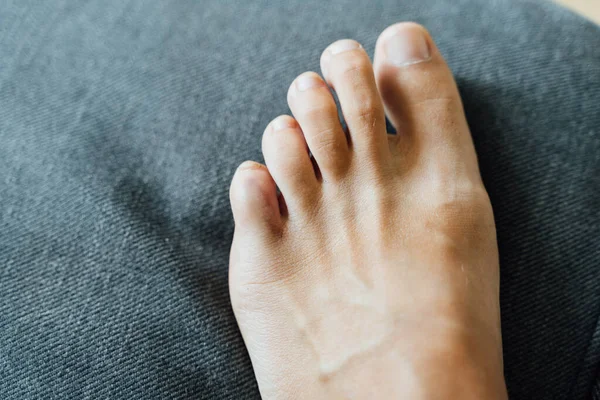 Blessure au pied. Petite douleur aux orteils et ecchymoses après un accident domestique. Fracture de Phalange. ongles nus en bonne santé. — Photo