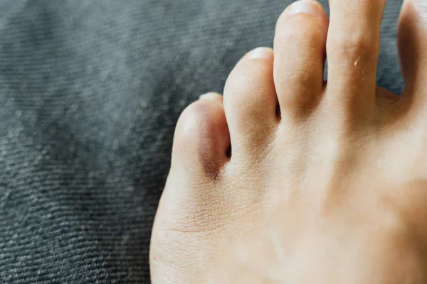 Fotlillfingret skadat. Smärta i tån och blåmärken efter hemolyckan. Halvledarfraktur. Barfota naglar friska. — Stockfoto