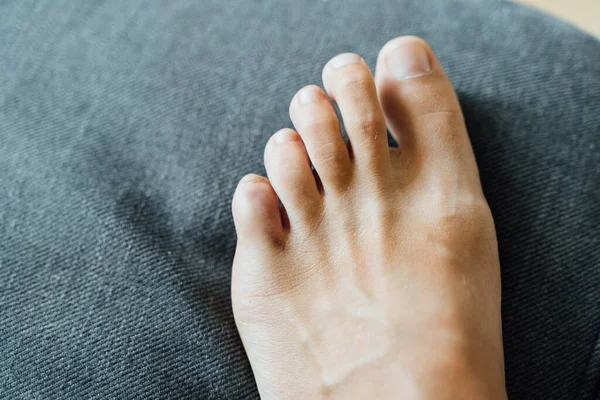 Lesión en el dedo meñique. Dolor en el dedo del pie y moretones después de un accidente. Fractura de falange. Uñas descalzas saludables. — Foto de Stock