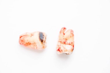 Kötü ağız hijyeninden dolayı diş bakımı veya çürüğü olarak da bilinen, beyaz arka planda izole edilmiş iki diş kaplaması.