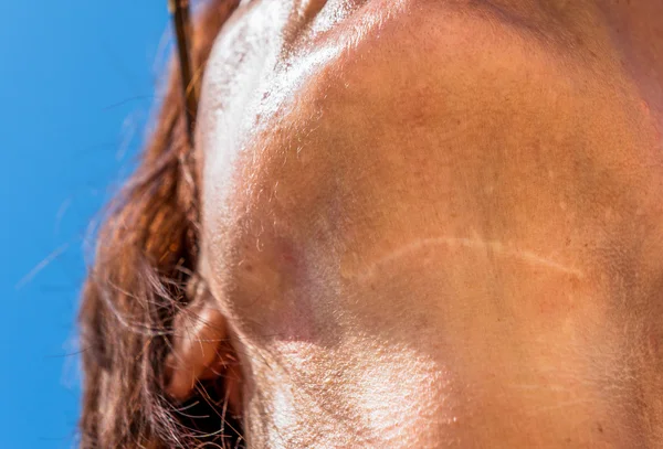 Een chirurgische nek litteken — Stockfoto