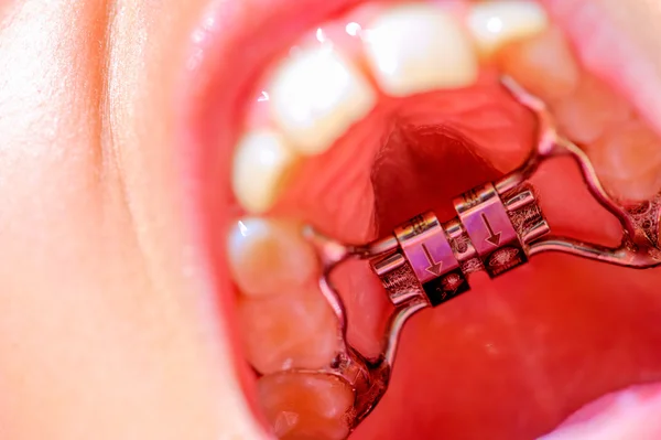 A new dental braces — Stock Photo, Image