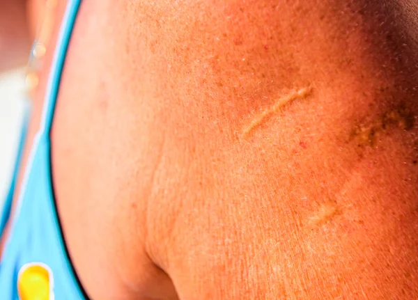 Operazione di successo con cicatrici alla spalla — Foto Stock