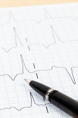 kalp tanı için kardiyogram kavramı üzerinde kalem
