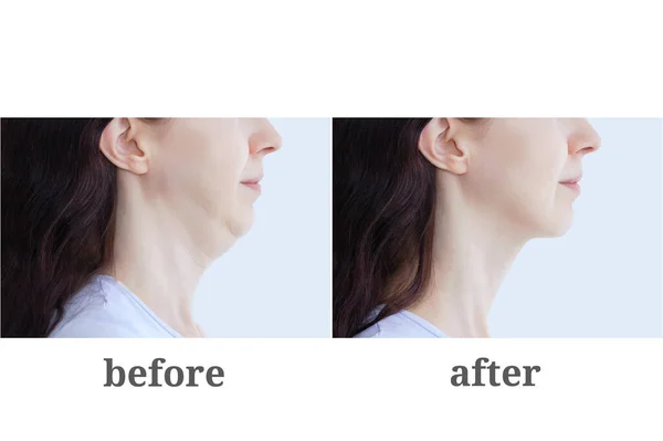 Platysmoplasty Removal Double Chin Caucasian Woman Photos — Stock Photo, Image
