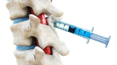 Omurilikteki şırınga beyaz bir arka planda izole edilmiş. Epidural enjeksiyonlu omurga ya da omurga tedavisi 3 boyutlu görüntüleme. Tıbbi ve sağlık, anatomi, tıp konsepti.