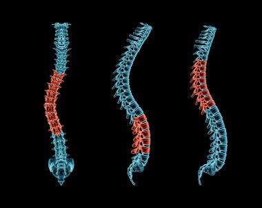 Omurga röntgeni, omurga eğriliği, lordosis ve kifoz duruşu. Patolojik omurlar kırmızıyla işaretlenmiş. Omurga bozukluklarının insan kıvrımları 3 boyutlu resimleme. Tıbbi ve sağlık, tıp ve anatomi konsepti.