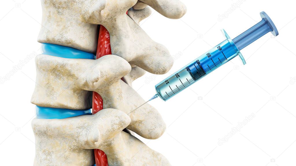 Facet joint injection, therapy against backbone injury or pain. Close-up of vertebrae with a syringe isolated on a white background 3D rendering illustration. Medical and healthcare, anatomy, medicine concept.